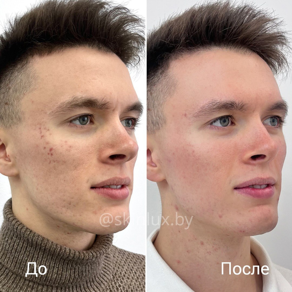 Лазерная шлифовка_до-после.jpg Лазерная шлифовка_до-после.jpg