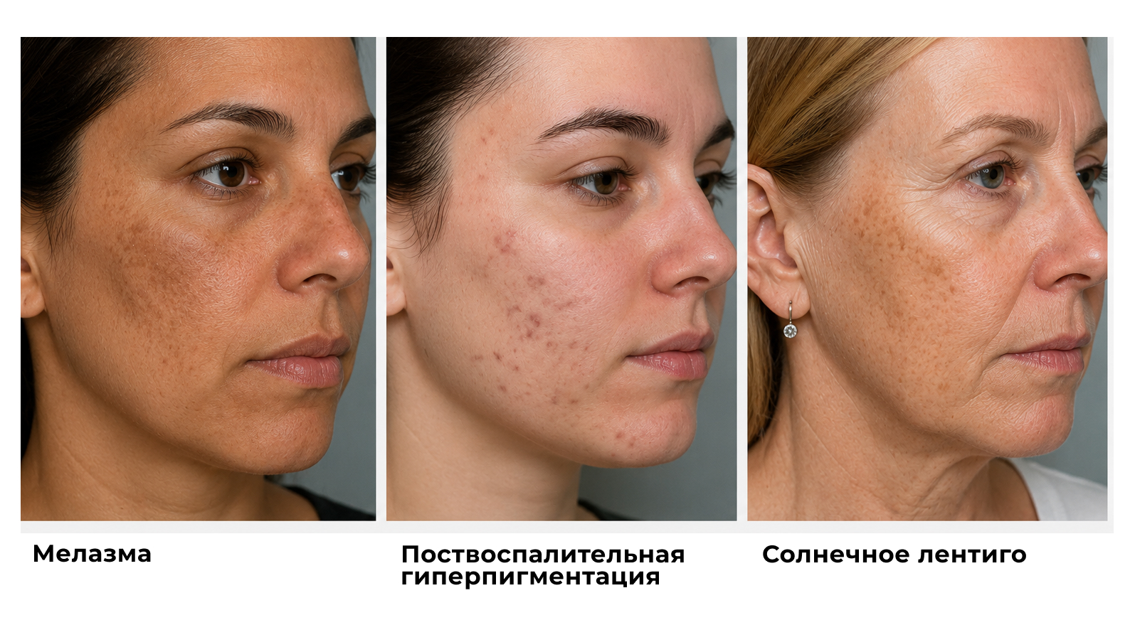 Типы пигментации.jpg